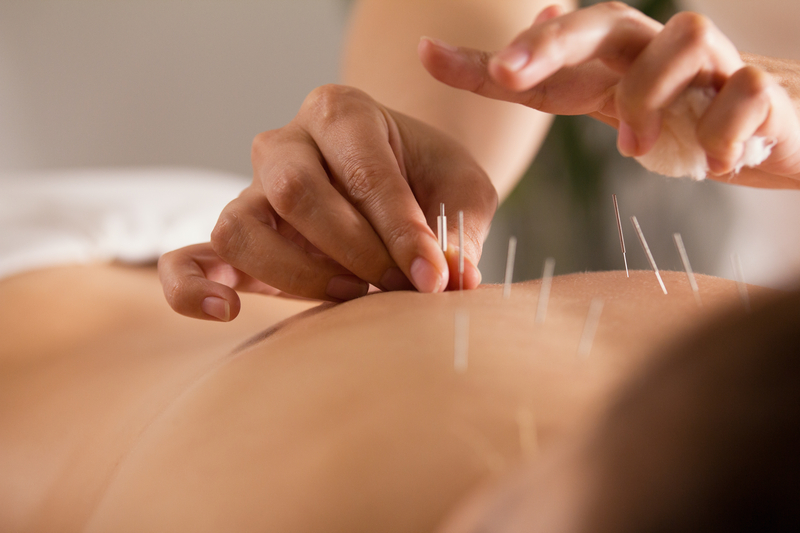 Acupuncture Acupuncture